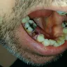 Western Dental Services - tooth extraction - Photo 1