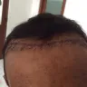 DHI Global - Hair transplant - Photo 1