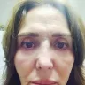 International Advanced Surgical Institute - Nose injection