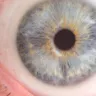 International Specialist Eye Centre [ISEC] - Strabismus surgery damaged my eye - Photo 1