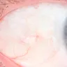 International Specialist Eye Centre [ISEC] - Strabismus surgery damaged my eye - Photo 2