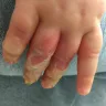 Ruby Tuesday - child's hand burnt - Photo 1