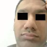 Dr. Anil R. Shah, MD - Rhinoplasty - Photo 1