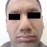 Dr. Anil R. Shah, MD - Rhinoplasty - Photo 3