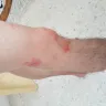 Billion Stars Express - bed bug bite - Photo 1