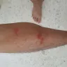 Billion Stars Express - bed bug bite - Photo 2