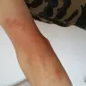 Billion Stars Express - bed bug bite - Photo 3