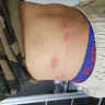 Billion Stars Express - bed bug bite - Photo 4