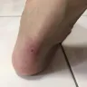 Skechers USA - product material not good, after wear few hours, my feet get have wound - Photo 1