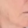 Dr. Renato Calabria - Facelift - Photo 1