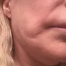 Dr. Renato Calabria - Facelift - Photo 2