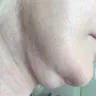 Dr. Renato Calabria - Facelift - Photo 3
