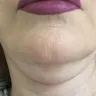 Dr. Renato Calabria - Facelift - Photo 4