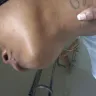 Hotels.com - bites from bed bugs - Photo 8