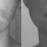 Dr Timothy J Marten - facelift and forehead temple lift - Photo 1