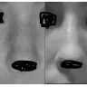 Dr Timothy J Marten - facelift and forehead temple lift - Photo 3