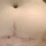 Dr. Jaime Caloca - horrible tummy tuck