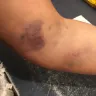 American Red Cross - negligence with inexperienced phlebotomist - Photo 2