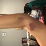 American Red Cross - negligence with inexperienced phlebotomist - Photo 3