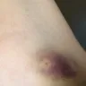 American Red Cross - injury incurred from donating blood on 6/29/17 in rochester, ny - Photo 1