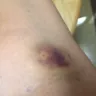 American Red Cross - injury incurred from donating blood on 6/29/17 in rochester, ny - Photo 3