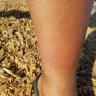 Motel 6 - I am complaint about my wife's both legs got infection from ur bed in room!! - Photo 3
