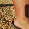 Motel 6 - I am complaint about my wife's both legs got infection from ur bed in room!! - Photo 4