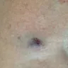 Quest Diagnostics - bad blood draw, left a very largemark on left arm, had to see a doctor - Photo 1