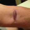 Quest Diagnostics - bad blood draw, left a very largemark on left arm, had to see a doctor - Photo 2