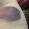 LabCorp - severe bruises after three attempts to draw blood from my left arm - Photo 1