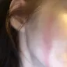 Instyler - second degree burn on face - Photo 2