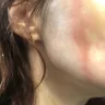 Instyler - second degree burn on face