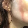 Instyler - second degree burn on face - Photo 3