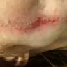Instyler - second degree burn on face - Photo 1