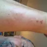 La Quinta Inns & Suites - bed bug bites