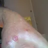 La Quinta Inns & Suites - bed bug bites - Photo 2