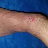 Motel 6 - I was bit by bed bugs : (my ankle is rotting after weeks and my arm is messed up too... - Photo 1