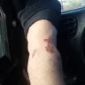 Motel 6 - I was bit by bed bugs : (my ankle is rotting after weeks and my arm is messed up too... - Photo 2