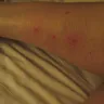 Priceline.com - bed bugs and my bites in my las vegas, nv hotel arizona charlie's