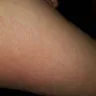 Motel 6 - bed bugs - Photo 1