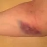 LabCorp - staff not trained to draw blood! - Photo 1