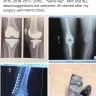 Mayo Clinic - total knee replacement - Photo 2