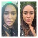 Revitalize in Turkey - Rhinoplasty - Photo 1 - comment #2154454