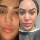 Revitalize in Turkey - Rhinoplasty - Photo 1 - comment #2160945