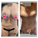 Revitalize in Turkey - Breast reduction lift , implant. 3 area lipo - Photo 1 - response #2251234