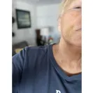 Aspen Dental - Extraction of impacted wisdom tooth  - Photo 1 - update #2255549