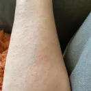 Arbonne - allergic reaction - Photo 1 - comment #2138951