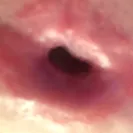 Strax Rejuvenation - Bad Cosmetic Surgery - Photo 1 - comment #2041204