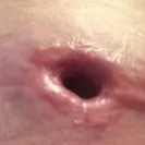 Strax Rejuvenation - Bad Cosmetic Surgery - Photo 2 - comment #2041204