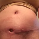 Strax Rejuvenation - Bad Cosmetic Surgery - Photo 3 - comment #2041204